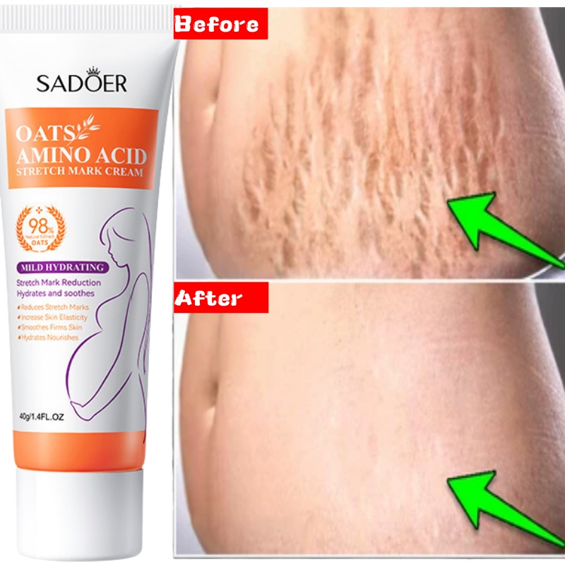 Skincare Oat - ครีมลบรอยแตกลายถาวร ลดรอยแตกลายที่หน้าท้อง ลดรอยบวม ซ่อมแซมรอยแตกผิว บำรุงผิวให้กระชับ
