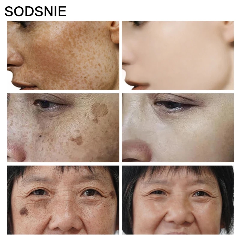 เครื่องกำจัดจุดด่างดำวิตามินซี - Skincare Niacinamide บทวิจารณ์และราคา